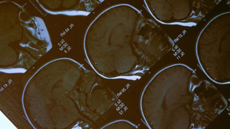 DETECTAN QUÉ PARTE DEL CEREBRO ES LA MÁS DAÑADA POR LAS ADICCIONES A LA COCAÍNA Y A LA HEROÍNA