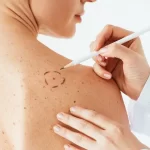 VACUNA DE MODERNA Y MERCK CONTRA EL MELANOMA SUPERA CON ÉXITO LA FASE AVANZADA DE ENSAYOS CLÍNICOS