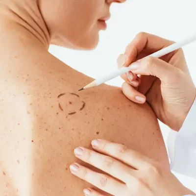 VACUNA DE MODERNA Y MERCK CONTRA EL MELANOMA SUPERA CON ÉXITO LA FASE AVANZADA DE ENSAYOS CLÍNICOS