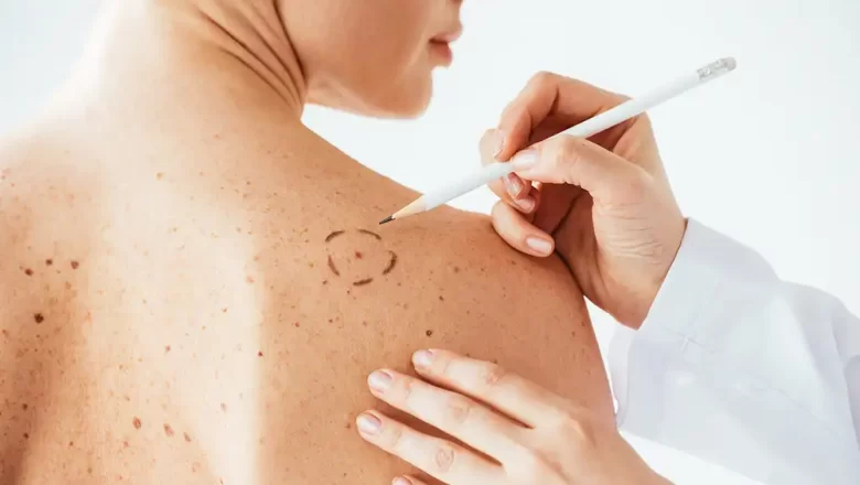 VACUNA DE MODERNA Y MERCK CONTRA EL MELANOMA SUPERA CON ÉXITO LA FASE AVANZADA DE ENSAYOS CLÍNICOS