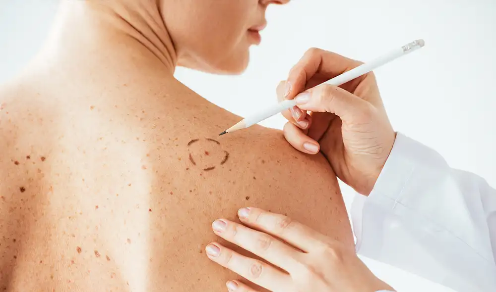 cáncer de piel